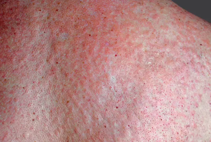 Qué es la Fiebre Manchada y cuáles son sus síntomas