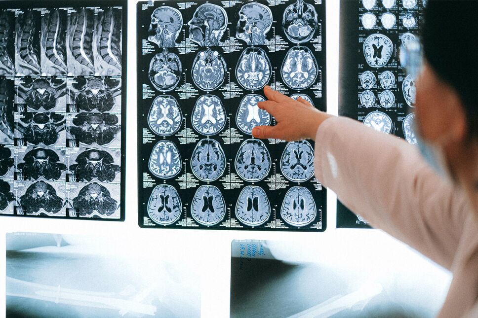 alzheimer