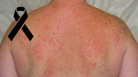 El sarampión es una enfermedad altamente contagiosa que afecta principalmente a menores de edad