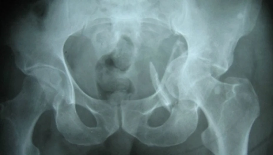 Osteoporosis