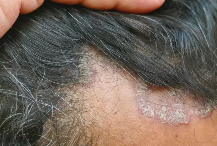 No salgas en la noche: La rara, pero mortal infección por mosquitos que alerta en Massachusetts