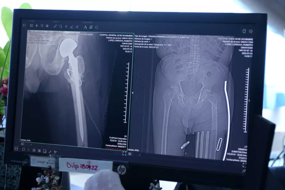Implante cadera issste.jpeg