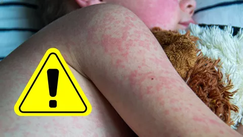 Confirman séptimo caso de sarampión en Aguascalientes una niña vacunada