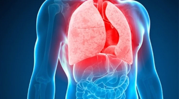 Cáncer de pulmón