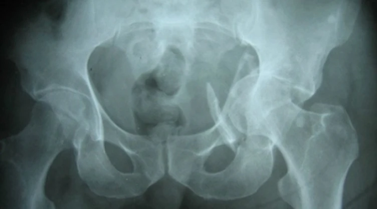 Osteoporosis