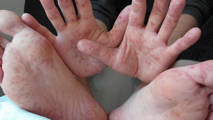 virus Coxsackie.jpg