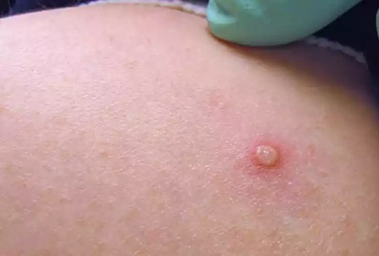 EUA declara emergencia sanitaria nacional por viruela del mono