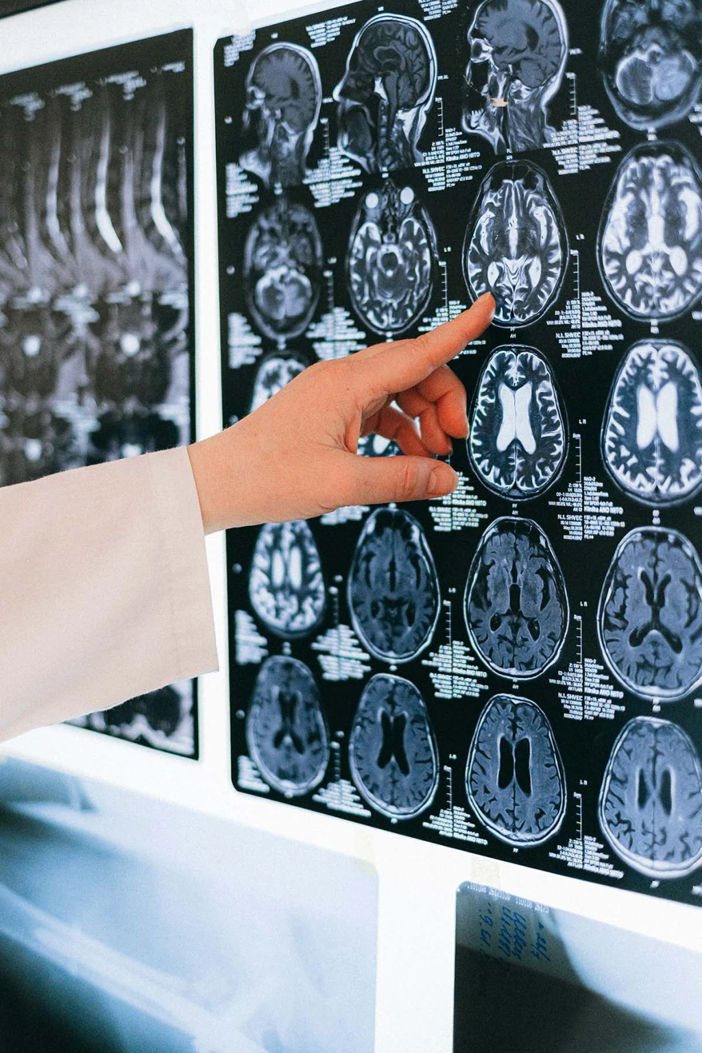 Derrames Cómo identificar un derrame cerebral