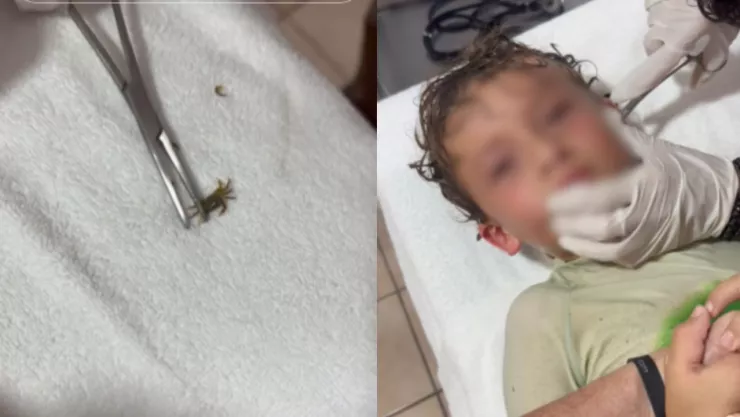 Cangrejo entra al oído de un niño: así ocurrió el insólito caso