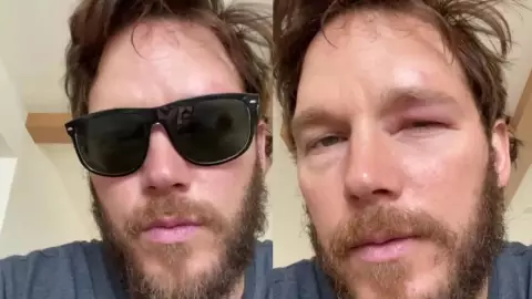 abeja le pica a chris pratt en el ojo