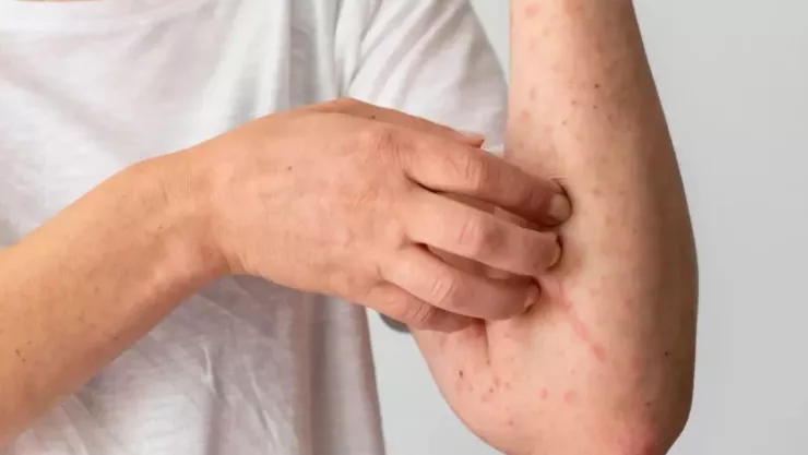 Confirmados 421 casos de sarampión en México, hasta 31 de ellos en Puebla