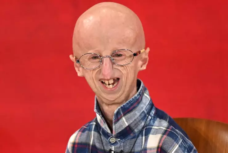 Sammy Basso fue el paciente con progeria que más vivió