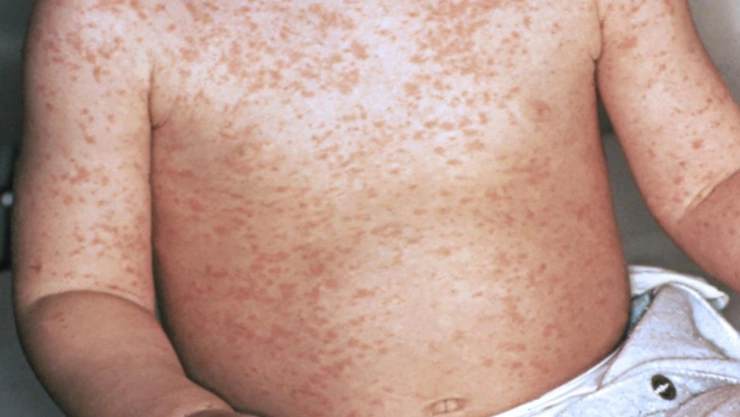 Brote de Sarampión en México