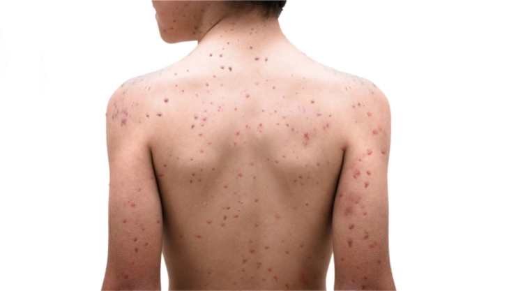 Varicela en Campeche: Aumentan casos previo al regreso a clases