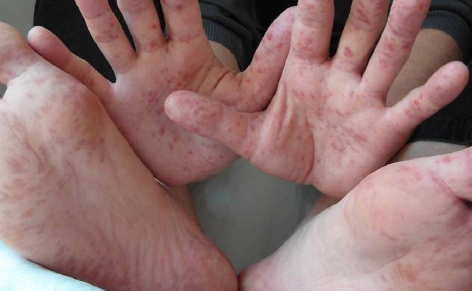 VIRUS COXSACKIE