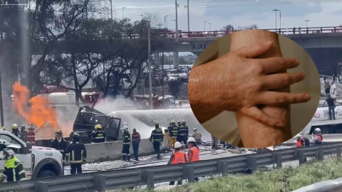 Aprende los cuidados para una quemadura por gas de primer, segundo y tercer grado. Información confiable y fácil de entender.