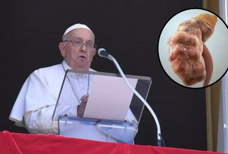 ¿Qué es la insuficiencia renal, la enfermedad que sufre el Papa Francisco hoy, domingo 23 de febrero?