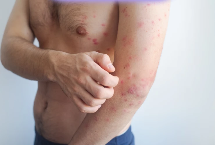 Lo que no sabías del sarampión.