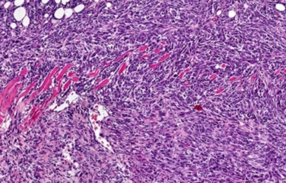 Cáncer