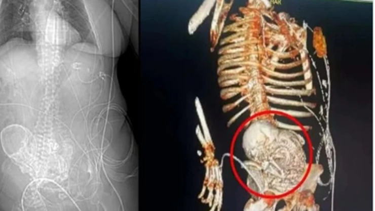 Muere mujer en hospital de Brasil tras encontrarle bebé de piedra durante cirugía