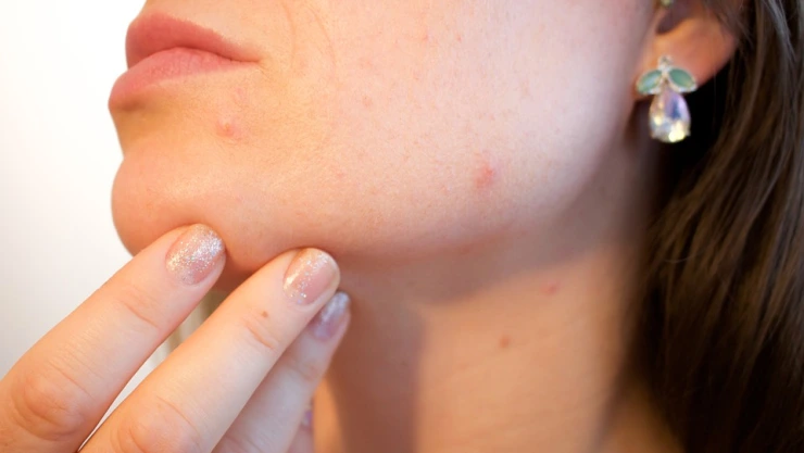 Parálisis facial aumenta en temporada invernal, dice especialista