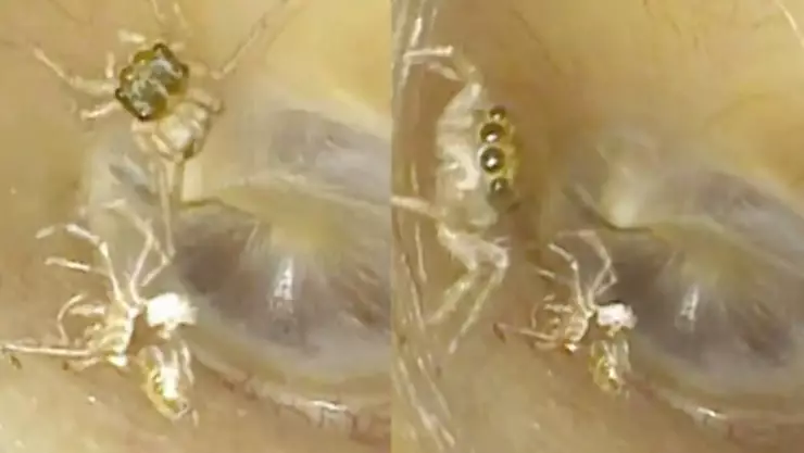 VIDEO: Escucha ruidos raros y acude al médico; tenía una araña en el oído