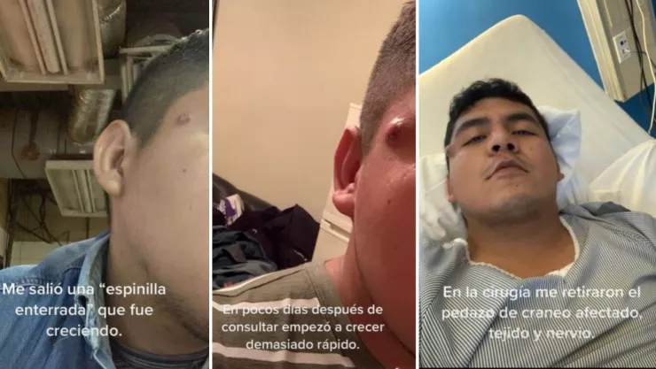 joven piensa que tiene una espinilla grano enterrada y resulta ser un tumor.jpg