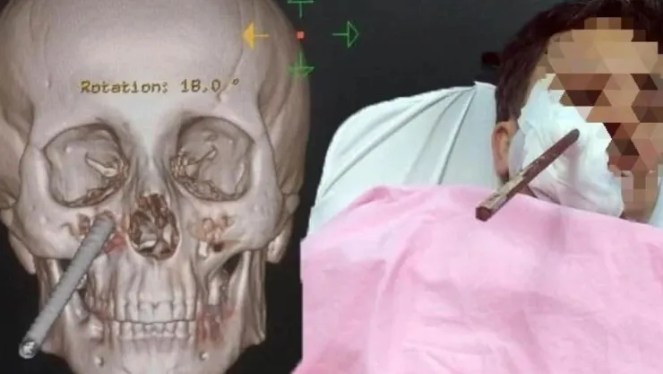 Hombre es atravesado por barra de acero cerca del cerebro y sobrevive