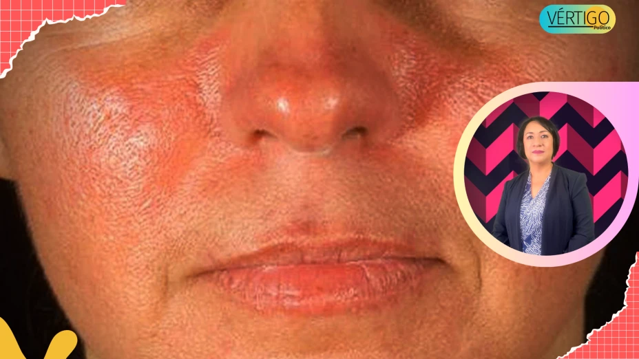 LUPUS