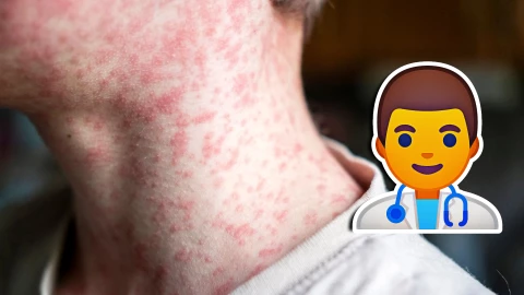 Sarampión en México_ Revelan cifra de muertos y casos confirmados en el país HOY 2 de septiembre de 2025.jpg