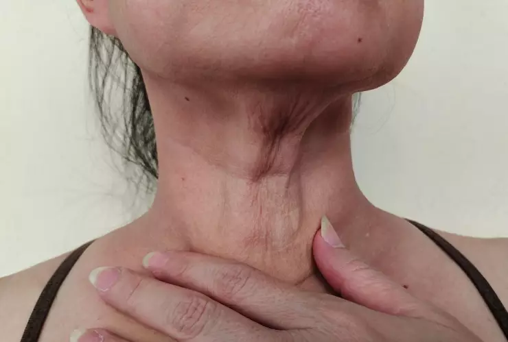 ¿Cómo hacer para que se caiga una verruga? La planta que te ayudará