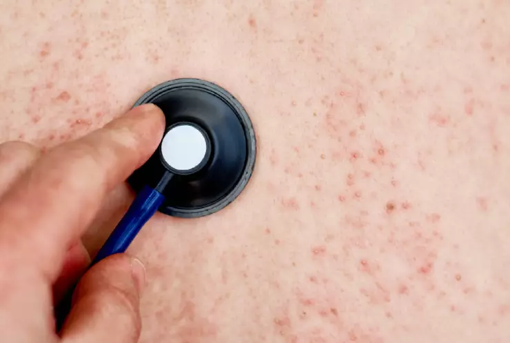 sarampión en Chihuahua.jpg