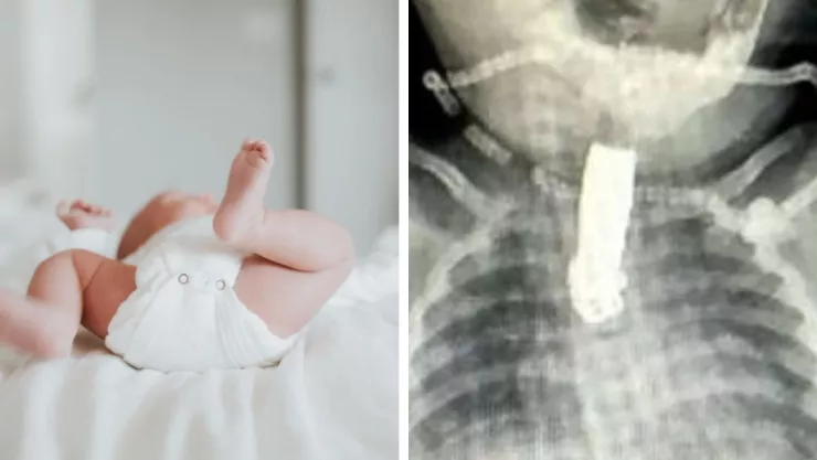 FOTOS Una bebé se traga un cortauñas y se le atora en la garganta