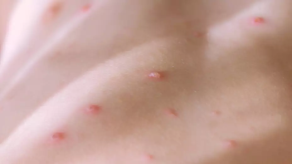 primer caso de sarampión en Parral