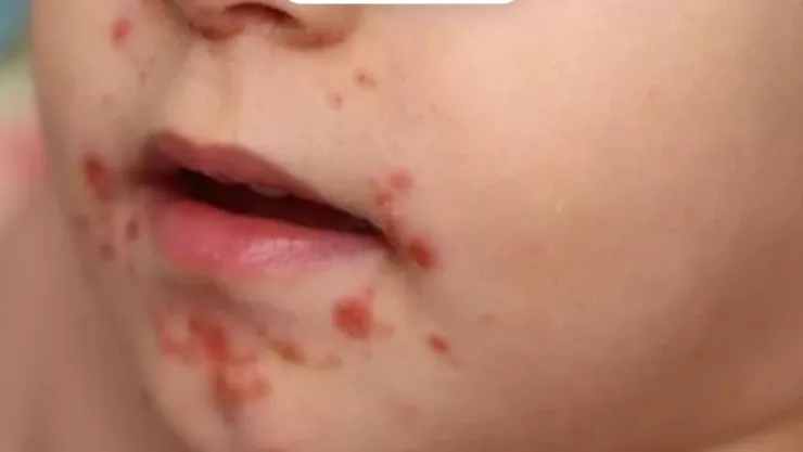 ¿Qué hacer si tu hijo se contagió de virus coxsackie en Baja California.jpg