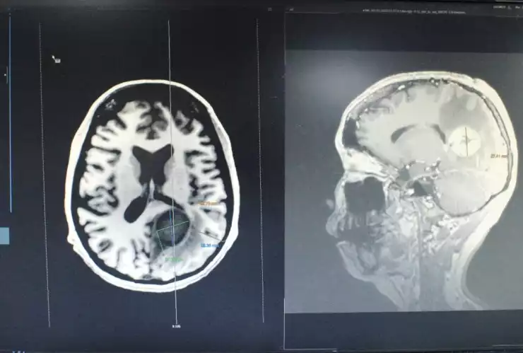 tomografía-tumor-cerebral-maligno-tamaño-huevo.jpg