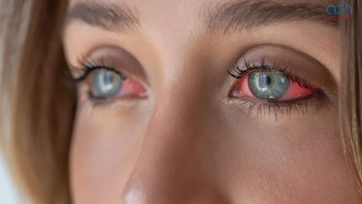 Síndrome Sjögren: Enfermedad poco común y que se caracteriza por los ojos rojos y la boca seca