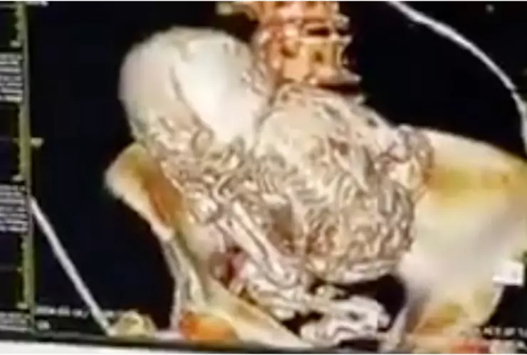 VIDEO_ ¡De no creérselo! Mujer va al doctor por un dolor y resulta ser un bebé calcificado