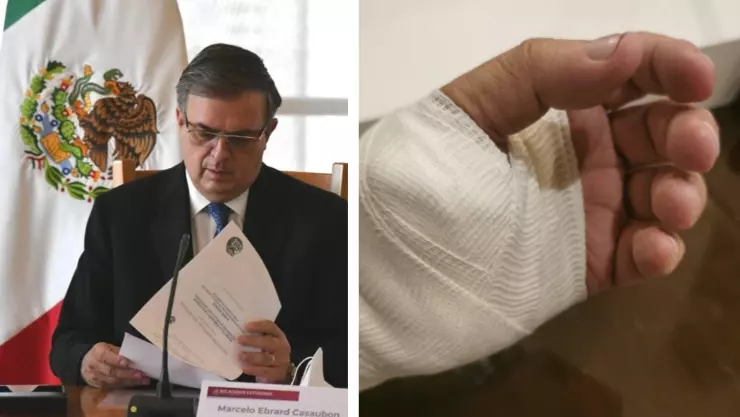 ebrard-mano-accidente (1).jpg