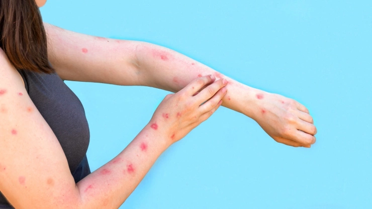 ¡No son los que esperabas! Los animales que contagian la viruela del mono