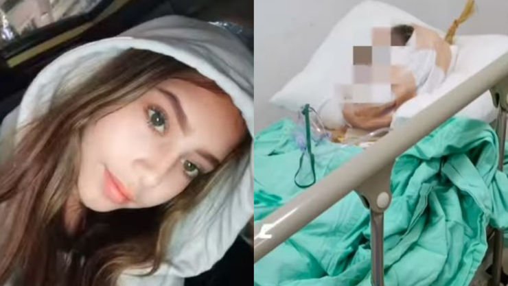 Adolescente quemaduras