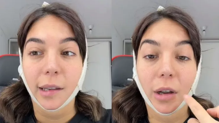 VIDEO de Luciana Milessi, tiktoker con parálisis facial por liposucción en papada por segunda vez