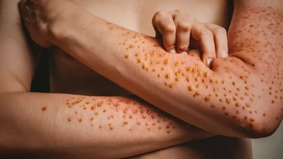 Alertan por peligroso aumento de casos de viruela del mono en México durante el 2025