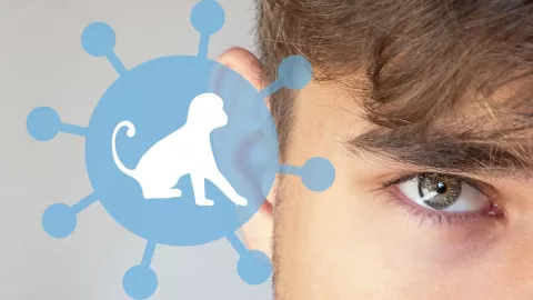 Estos son los síntomas de la Viruela de Mono