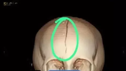 FOTO Granizo gigante golpea a niña y le provoca grave lesión craneal