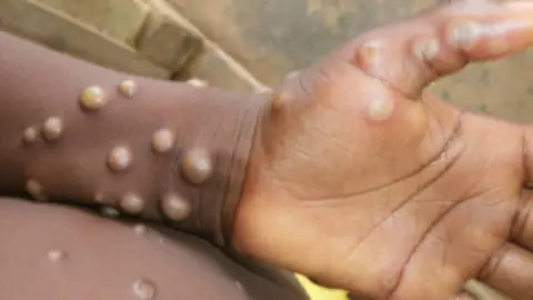 Viruela del mono o mpx_ OMS revela lo síntomas de la enfermedad