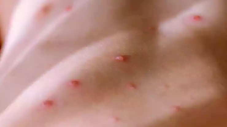 Reportan segundo caso de viruela del mono en Quintana Roo