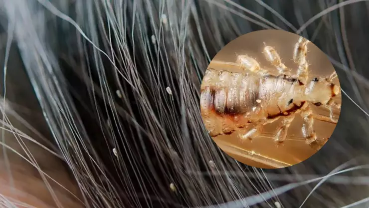 Cómo saber si mi hijo tiene piojos_ Cura y protección contra las liendres.jpg