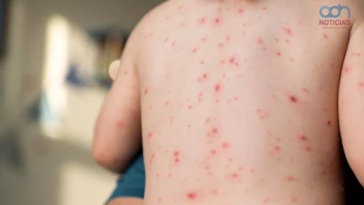 varicela_mexico_contagios.jpg
