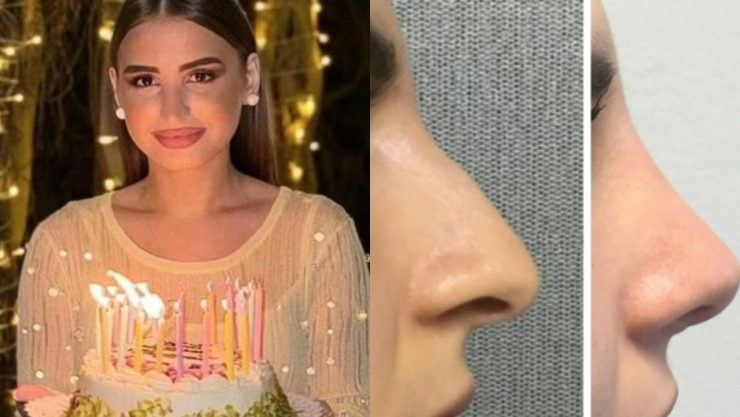Joven de 22 años muere tras realizarse una rinoplastia; encontró al doctor por TikTok